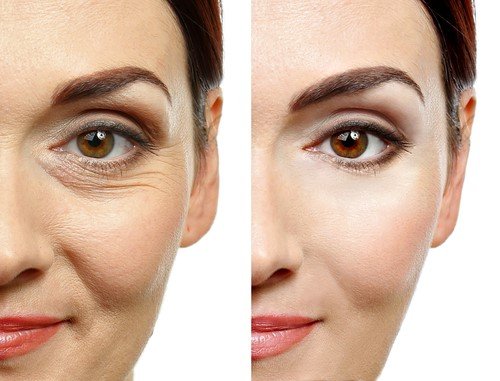 Wrinkle Def What Are The Different Types Of Wrinkle Treatment? – CPOYU